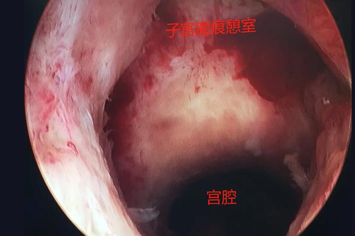 子宫肿大是炎症还是癌变,子宫肿大是炎症还是癌变引起的