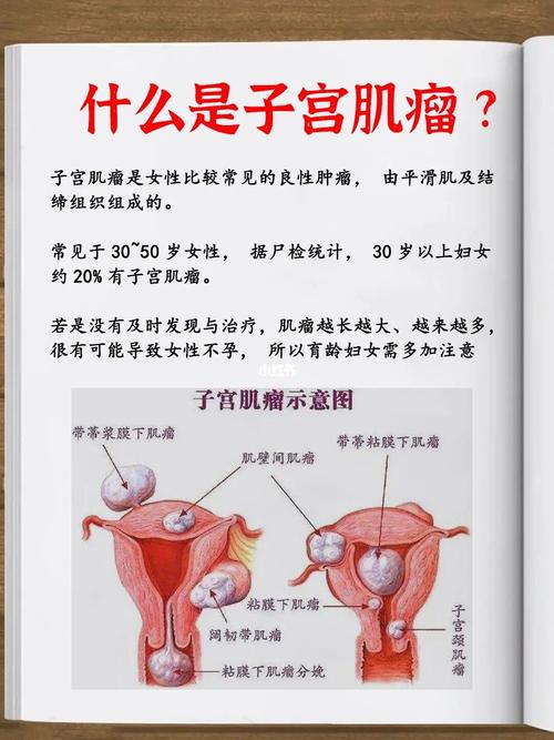 子宫肌瘤是淤血还是肉团,有子宫肌瘤的人脸上有什么表现